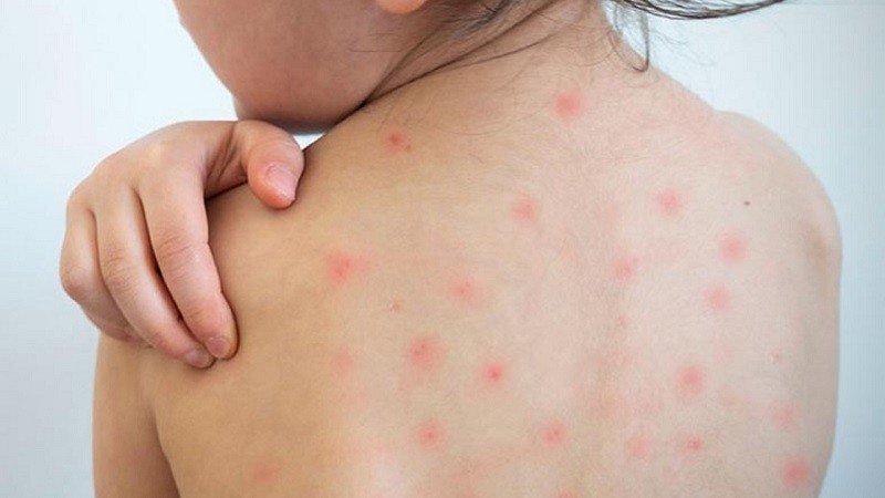 Another 9 Children Die from Measles and Symptoms